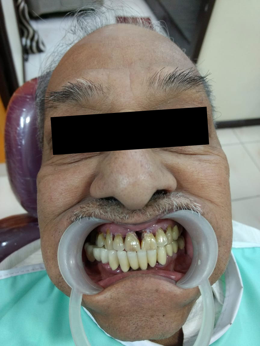 Full Mouth Rehabilitation Case 1