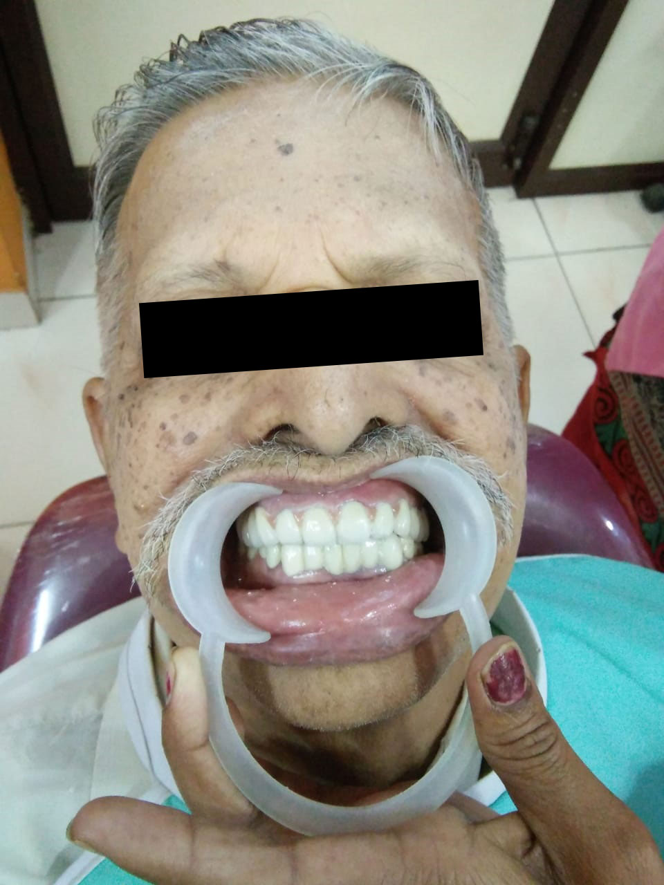 Full Mouth Rehabilitation Case 2 2
