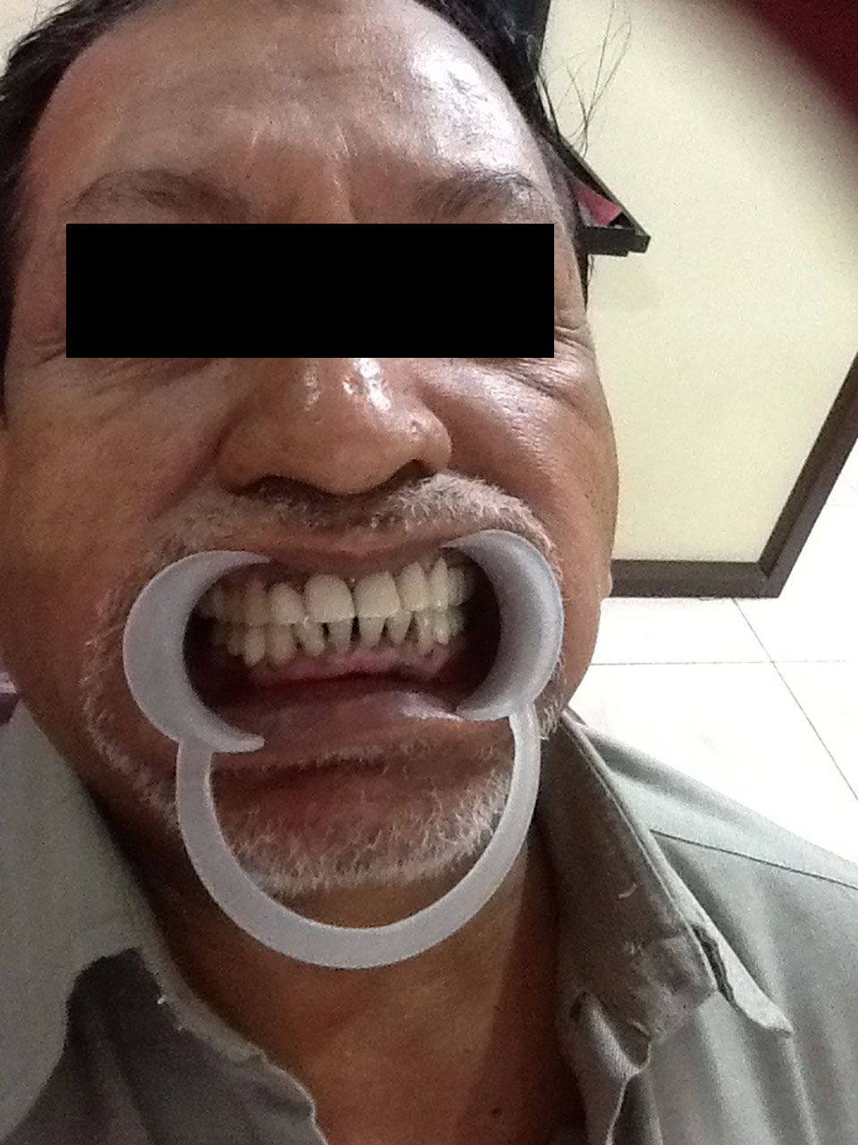 Full Mouth Rehabilitation Case 5
