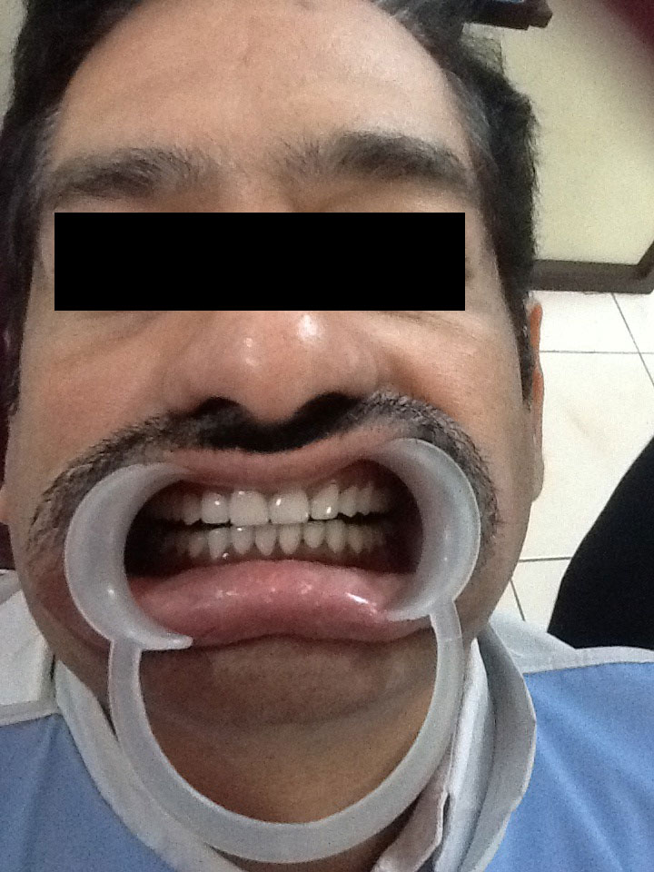 Full Mouth Rehabilitation Case 6