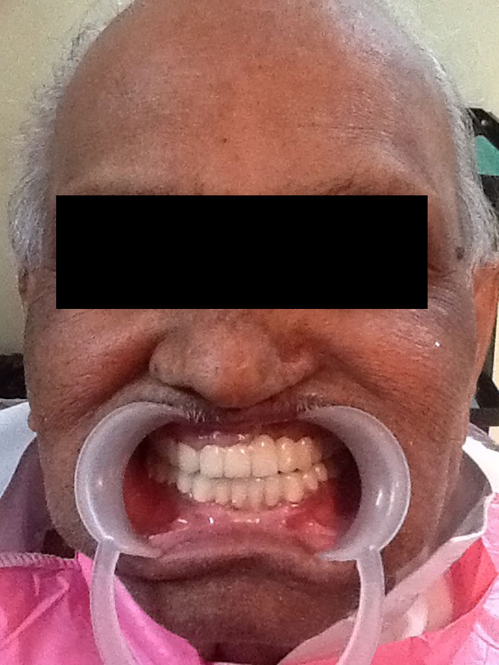 Full Mouth Rehabilitation Case 6
