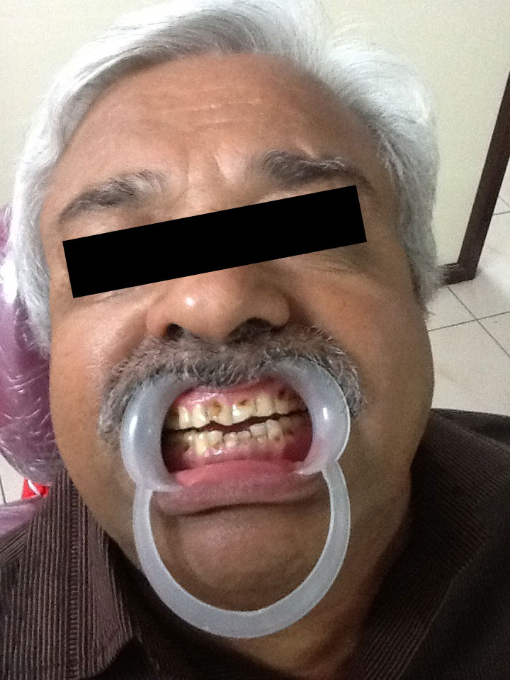 Full Mouth Rehabilitation Case 7