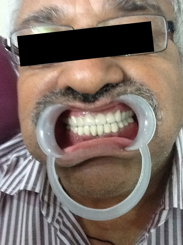 Full Mouth Rehabilitation Case 8 2