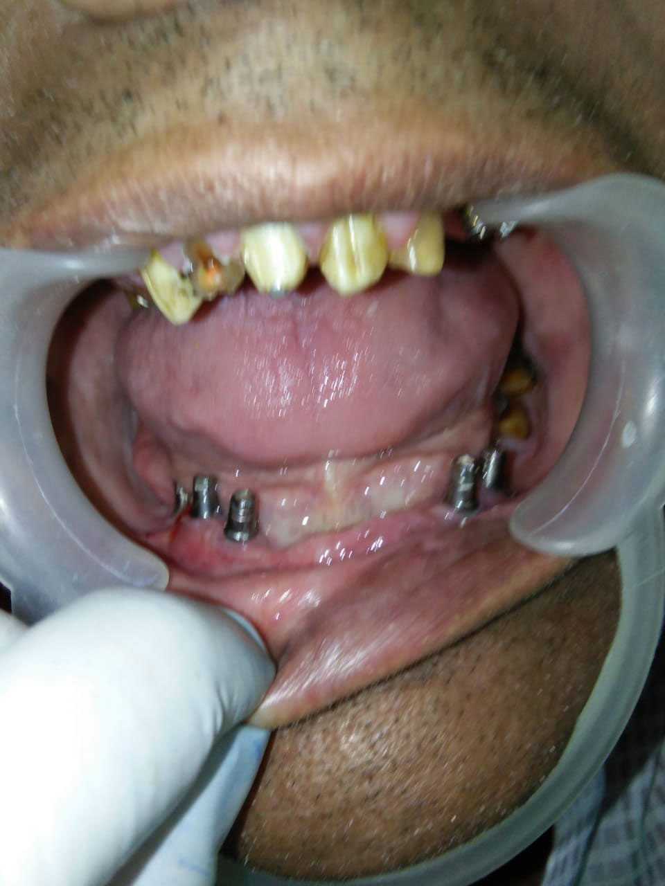 Implants Case 3