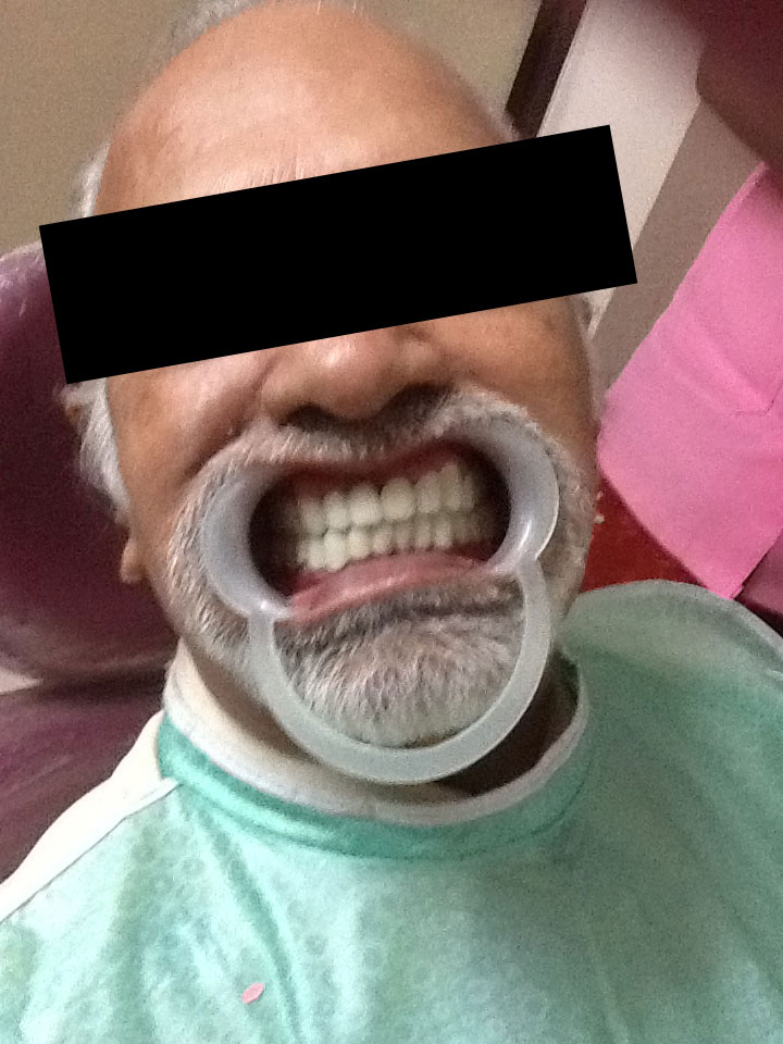 Full Mouth Rehabilitation Case 8