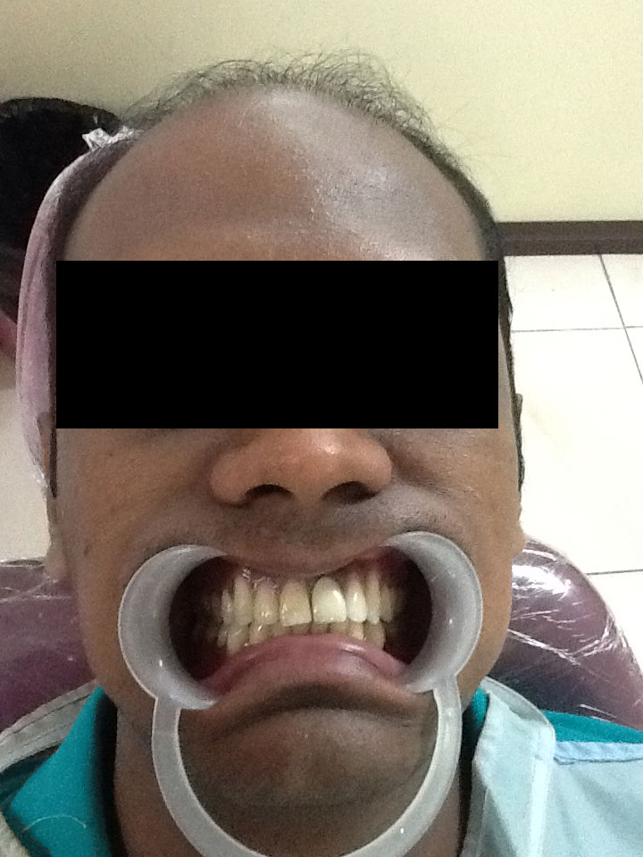 Broken Teeth case 3